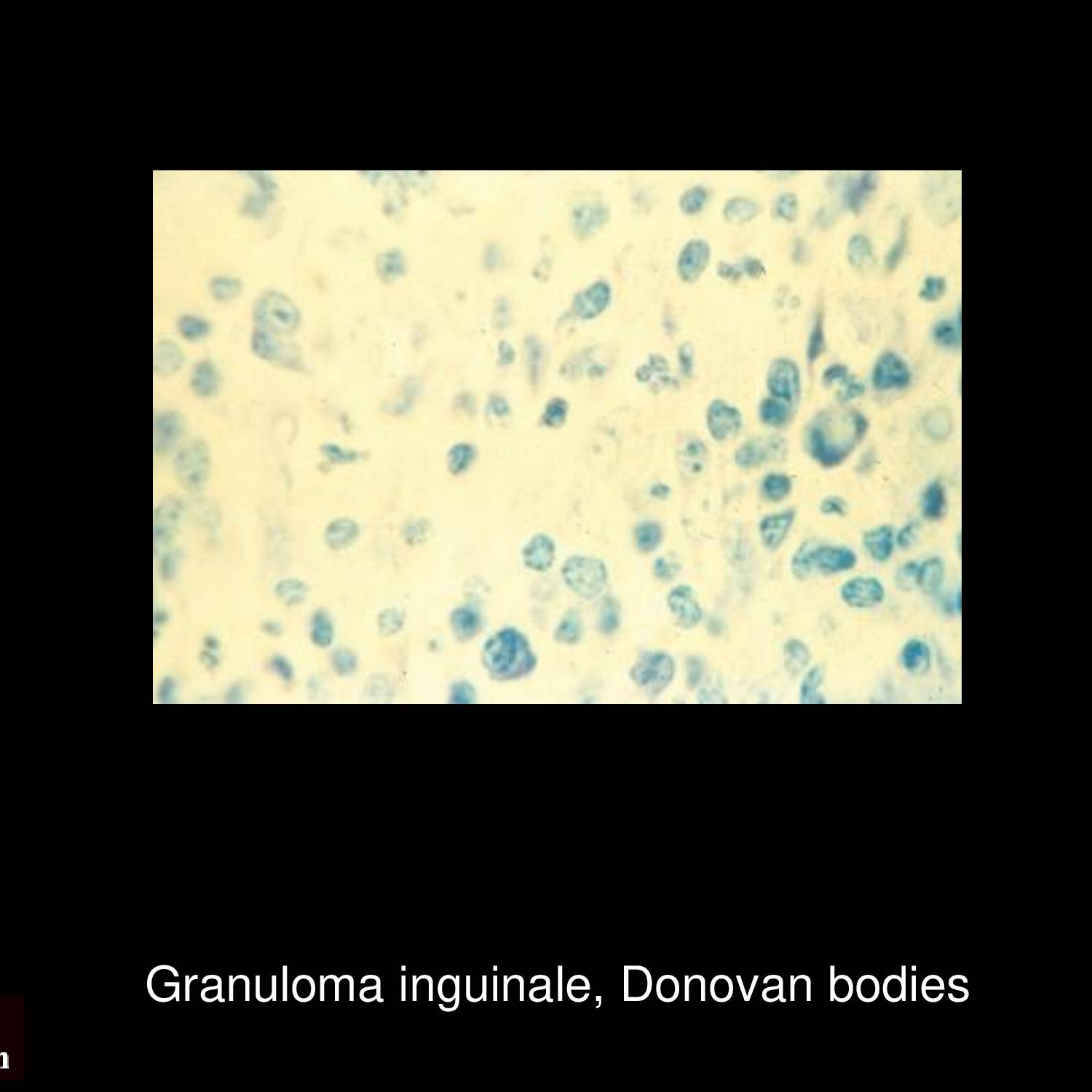 Granuloma inguinale lesion on perineum showing extensive ulceration with granulation tissue and surrounding hyperpigmentation from chronic infection